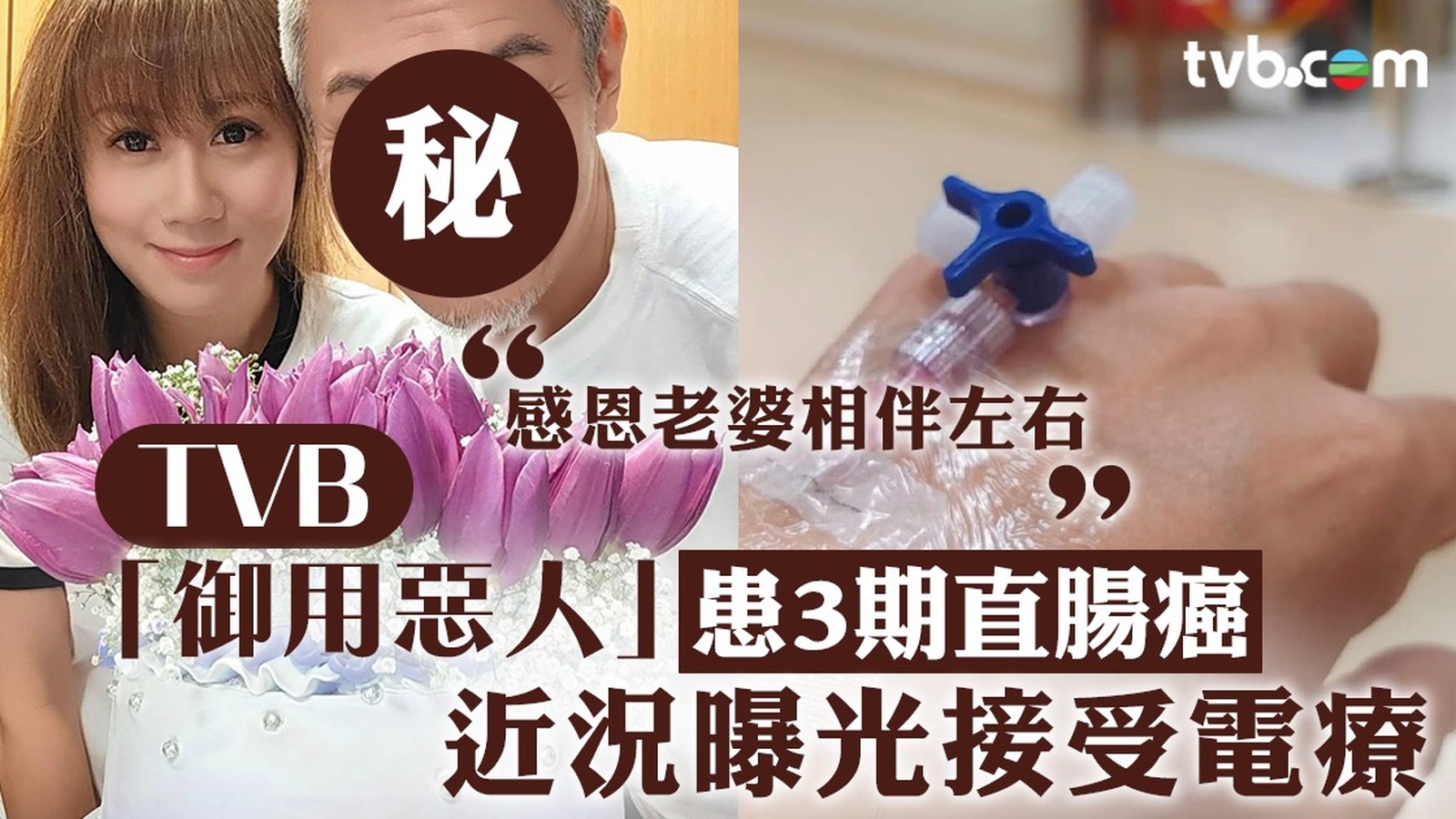 54歲TVB御用惡人患3期直腸癌  近況曝光接受電療：感恩老婆相伴左右